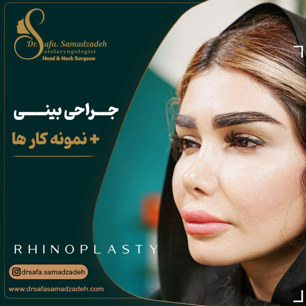 جراحی بینی - دکتر صمدزاده