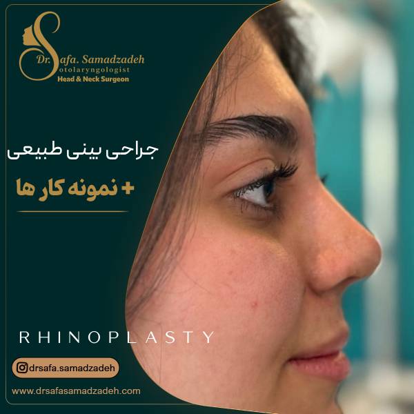 عکس مدل بینی طبیعی عمل شده در تهران | دکتر صمد زاده