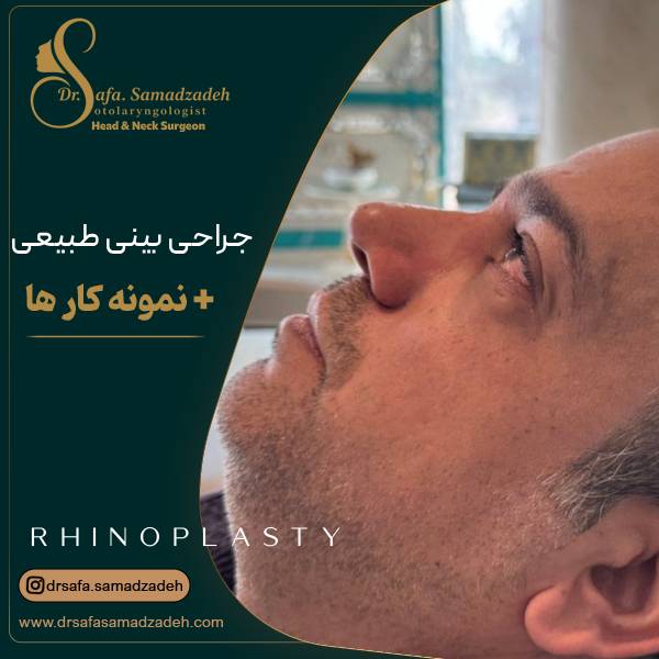 عمل بینی طبیعی و نچرال در تهران | دکتر صمد زاده