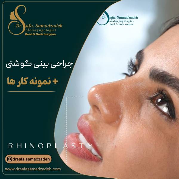 عمل بینی گوشتی با پوست ضخیم