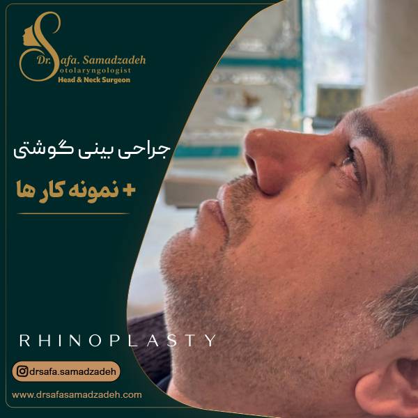 عمل بینی گوشتی | دکتر صفا صمدزاده